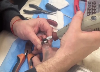 В результате успешного взаимодействия медиков и специалистов аварийно-спасательной службы удалось предотвратить потерю пальца у несовершеннолетнего пациента